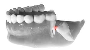 Wisdom Teeth Removal